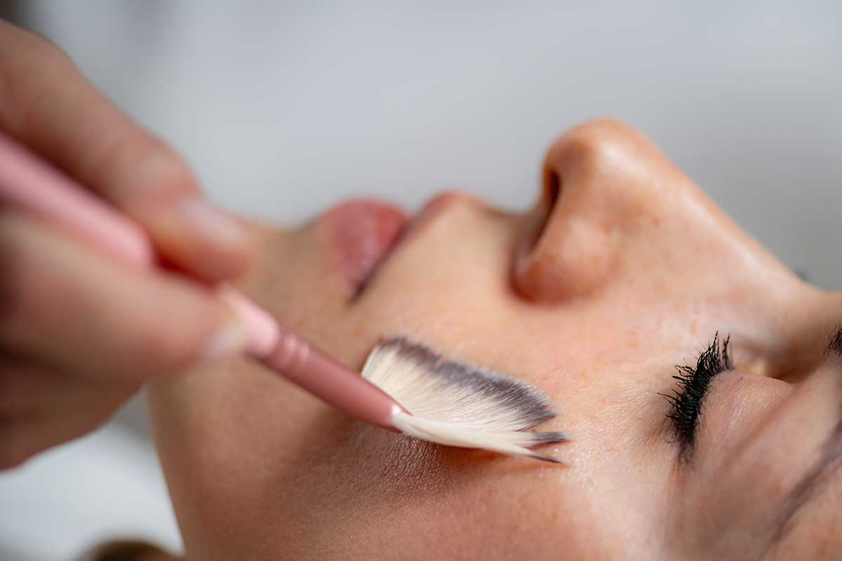 Chemical Peel in Greenock / Scotland